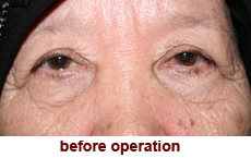 plastic-surgery-blepharoplasty